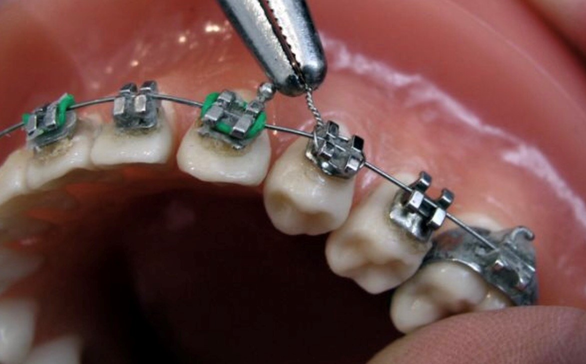 Orthodontic Elastomeric Ligatures With Different Dimensions